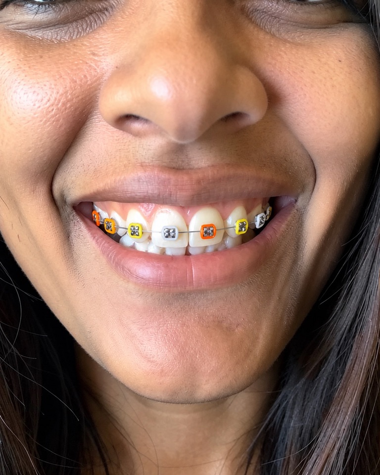 Close-up AI preview of a smile with metal braces and elastic ties in a repeating orange, yellow and white pattern