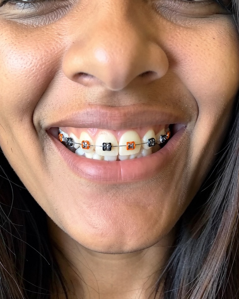 Close-up AI preview of a smile with metal braces and alternating orange and black elastic ties